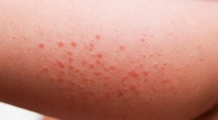 Different Types of Rashes - Eczema Free Skin