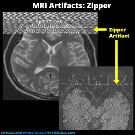 Morie Artifact Mri