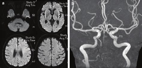 MRI the day after treatment (a: diffusion-weighted MRI, b: MRA ...