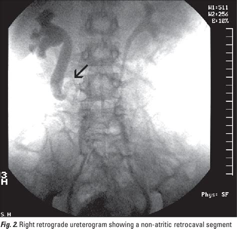 Figure 2 from Robotic uretero-ureterostomy of the retrocaval ureter without excision of the ...