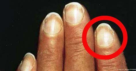 7 Fingernail Problems Never to Ignore - 98gag | Nail health signs, Nail health, Nail disorders