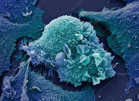 Lung cancer cells, SEM - Stock Image - C046/3487 - Science Photo Library