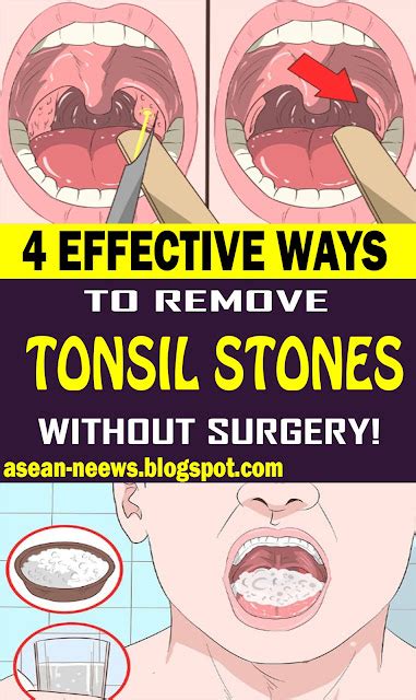 4 EFFECTIVE WAYS TO REMOVE TONSIL STONES WITHOUT SURGERY - HEALTH and ...