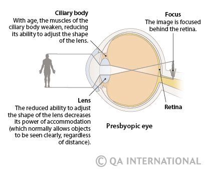 Ametropia: causes, symptoms, treatment – Healthy Food Near Me