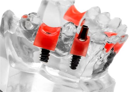 Dental Implant In One Day - Dental Clinics Turkey