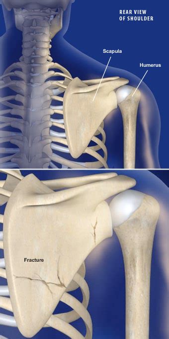 Back Bones Scapula : Scapula - Anatomy QA - Has a facet for the ...