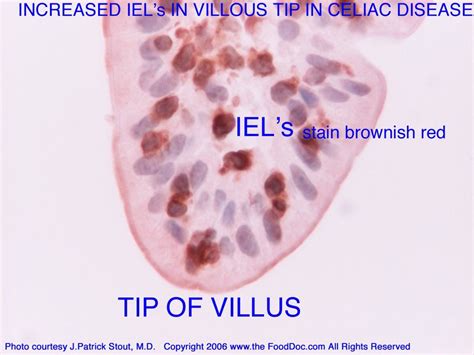 What are intra-epithelial lymphocytes, IEL’s and intra-epithelial lymphocytosis? The Food Doc ...