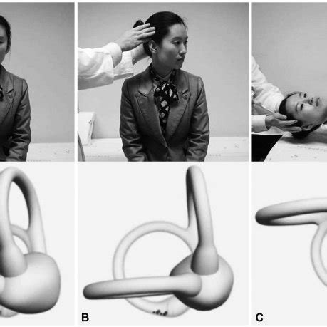 Nystagmus in left peripheral vestibulopathy. In unilateral peripheral... | Download Scientific ...