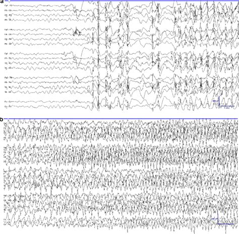 A clinically focal onset seizure in an 18-month-old girl with... | Download Scientific Diagram