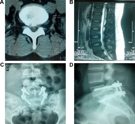 a case of Mis-TliF surgery. Notes: (A) lumbar CT shows l5/s1... | Download Scientific Diagram