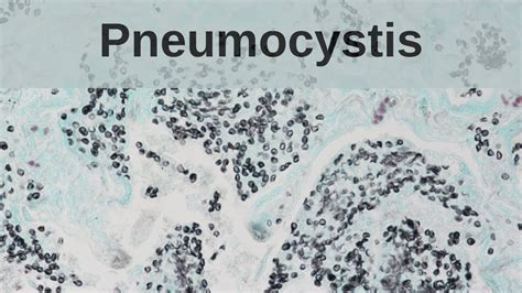 Pneumocystis Pneumonia - Pathology mini tutorial - YouTube