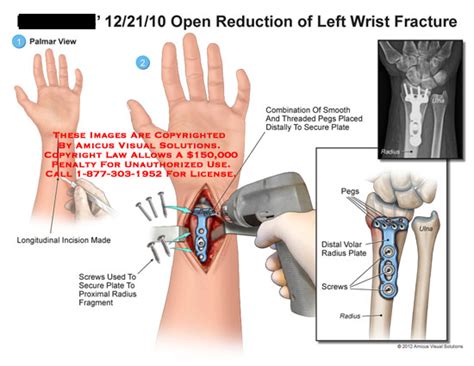 AMICUS Illustration of amicus,surgery,wrist,open,reduction,fracture,screws,plate,radius,fragment ...