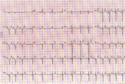 Intermittent delta waves mimics inferior myocardial infarction in young athlete