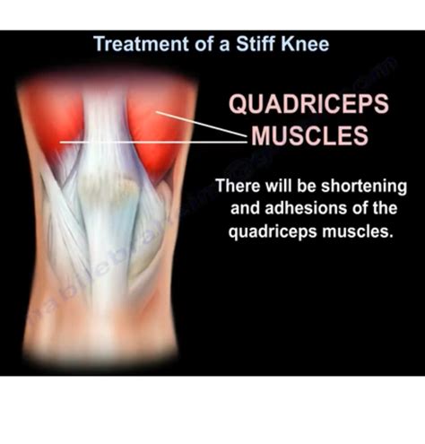 Treatment of a Stiff Knee — OrthopaedicPrinciples.com
