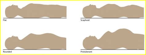 scaphoid abdomen - Google Search | Nursing School | Medical field ...