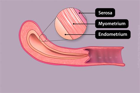 Patient Education: Hysteroscopy procedure - The Toronto Video Atlas of Surgery