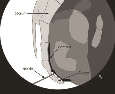 Ganglion Impar Nerve Block