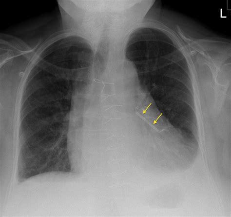 Watchman Left Atrial Appendage Closure Device Mri Safety