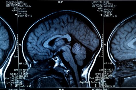 Examining the Potential of Neuroanatomical Imaging Signature for ...