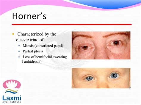 http://image.slidesharecdn.com/hornerssyndrome-140613071236-phpapp01/95/horners-syndrome-3-638 ...