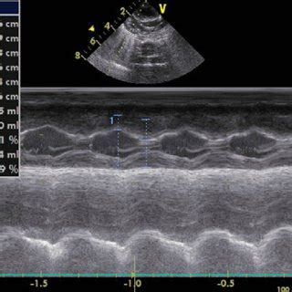 Echocardiography showing interventricular septum thickening (IVSd Z 0.6... | Download Scientific ...