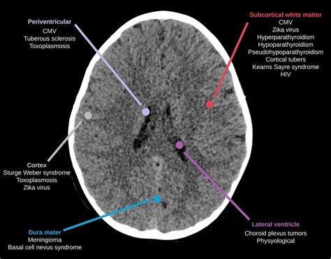 Common causes of supratentorial hemispheric calcification arising from... | Download Scientific ...