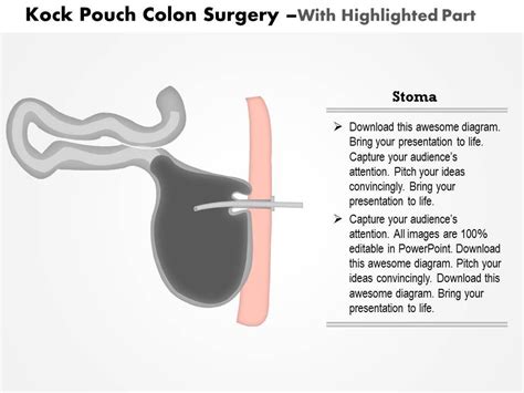 0914 Kock Pouch Colon Surgery Medical Images For PowerPoint | PowerPoint Slide Images | PPT ...