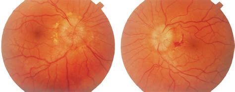 (Left) Right optic nerve. Typical signs of chronic papilledema with ...