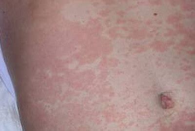 Maculopapular Rash - Pictures, Causes, Diagnosis