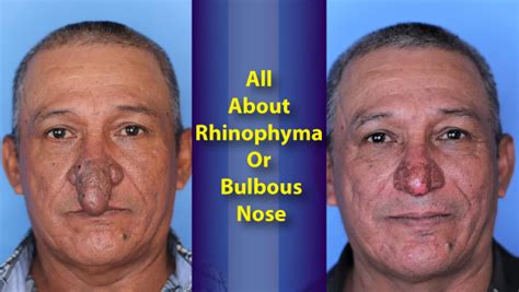 New York Man Treated For Rhinophyma Or Bulbous Nose: Causes, Symptoms And Treatment Of The ...