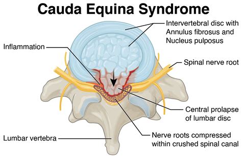 Cauda Equina Syndrome – C. Jones and Associates, LLC