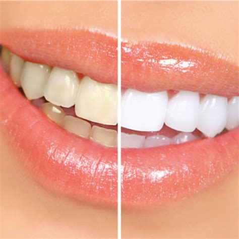 DIY Teeth Whitening: 5 Brilliant Tips for Whiter Teeth That Work ...