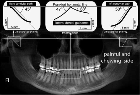 Understanding TMJ And Tinnitus And Finding Relief