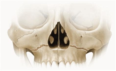 Correction of Le Fort I Fracture | Plastic Surgery Key