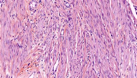 Uterine Leiomyoma