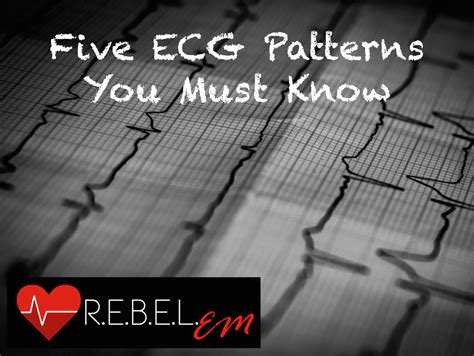 Five ECG Patterns You Must Know - REBEL EM - Emergency Medicine Blog