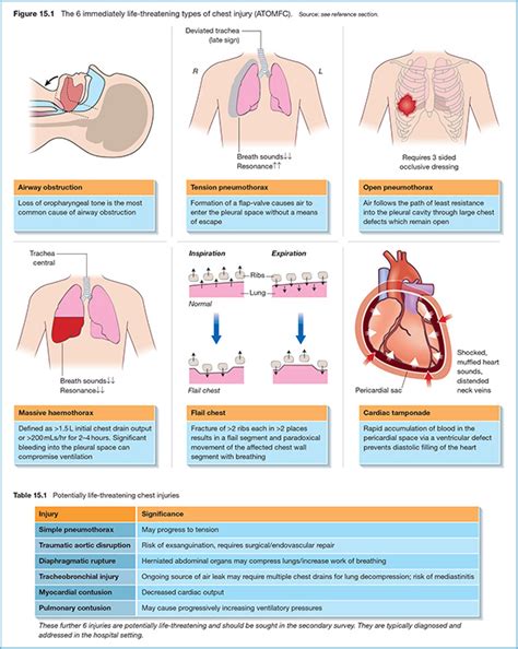 Life-threatening chest trauma | Anesthesia Key