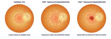 Macular Degeneration Memphis | Eye Disease Collierville - Southaven