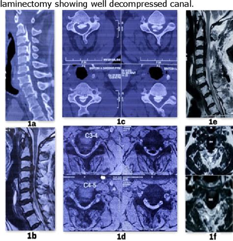 Figure 1 from Efficacy of Microscopic Posterior Cervical Laminectomy for Multilevel Compressive ...