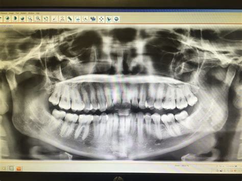 CBCT & Panoramic Scanner for Implant Placement