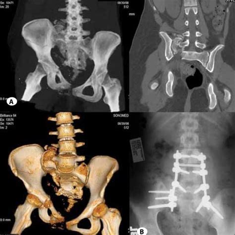 (PDF) Surgical Treatment in Sacral Fractures and Traumatic Spinopelvic ...