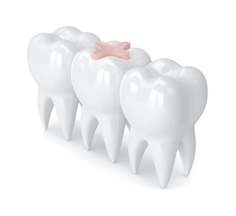 Is Cavity Treatment Permanent? - General Dentist in Laurel, MD