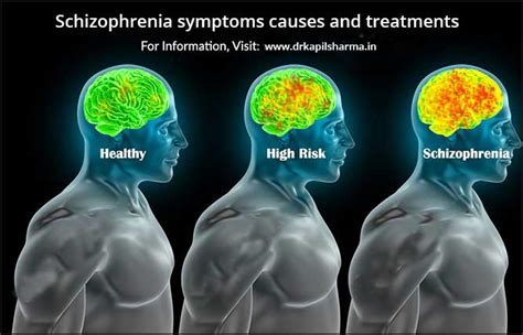 Schizophrenia symptoms causes and treatments - Dr. Kapil Sharma