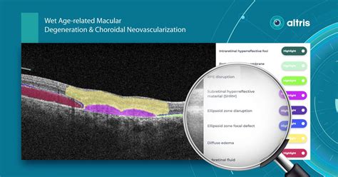 OCT Examination VS Fundus Photography: What to Choose