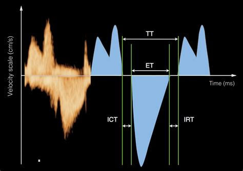 Pulsed Doppler in Fetal Echocardiography | Obgyn Key