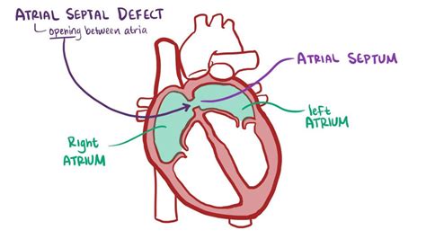 Atrial Septal Defect Types