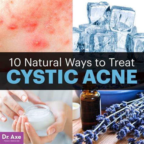 10 Natural Cystic Acne Treatments that Really Work | Cystic acne, Cystic acne treatment, Bad acne