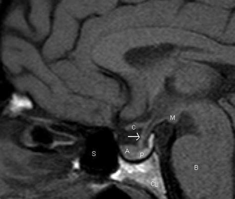 Radiology of the Pituitary - Endotext - NCBI Bookshelf