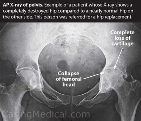 Osteonecrosis Of The Hip