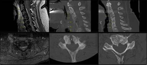 Frontiers | Case report: Anterior midline decompression of a cervical epidural abscess ...